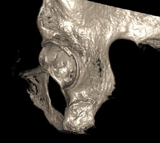 CT Pelvis Posterior Column